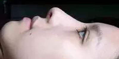 自體軟骨墊鼻尖術后