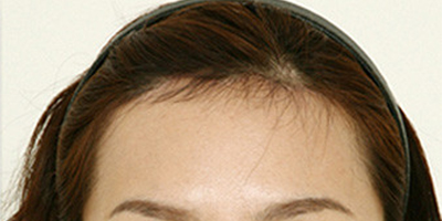 額頭縮小術(shù)后