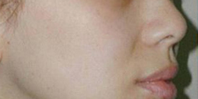 注射去法令紋術(shù)前