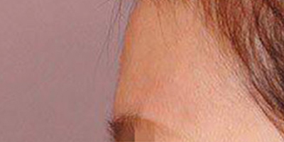 假體豐額頭術(shù)前