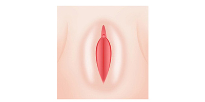 小陰唇手術術后