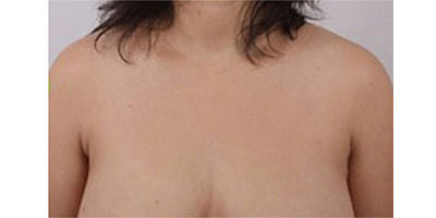 吸脂去副乳術(shù)后