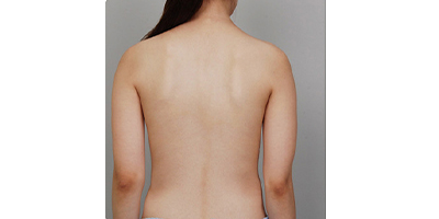 吸脂瘦背部術(shù)前