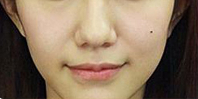 膠原蛋白填充蘋(píng)果肌術(shù)前