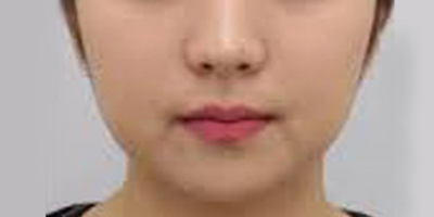 SMAS除皺術(shù)術(shù)前