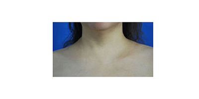 聚能震波吸脂術(shù)后