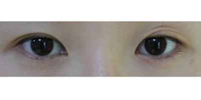 內(nèi)眥修復(fù)術(shù)術(shù)前