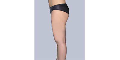 雙腿吸脂術(shù)后