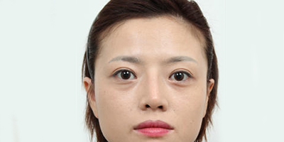 膨體隆鼻術(shù)后