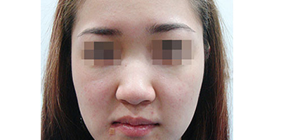 寬鼻矯正術前