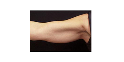 冷凍溶脂瘦手臂術前