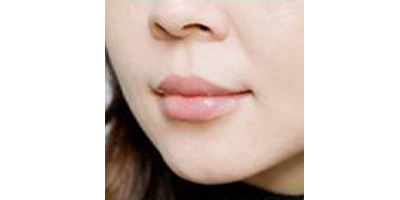 玻尿酸豐唇術(shù)后