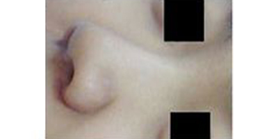 手術(shù)延長鼻小柱術(shù)前