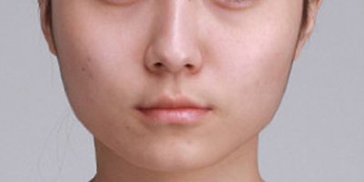 曼特波隆下巴術(shù)前