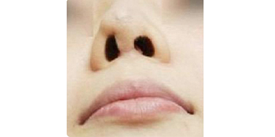 鼻部硅膠假體取出術(shù)前