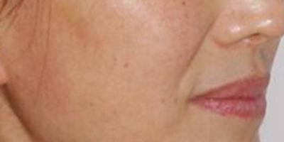 手術(shù)去法令紋術(shù)前