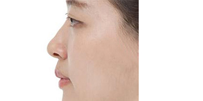 假體墊鼻基底術(shù)前