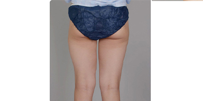 隔空溶脂瘦臀部術前