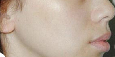 注射去法令紋術(shù)后