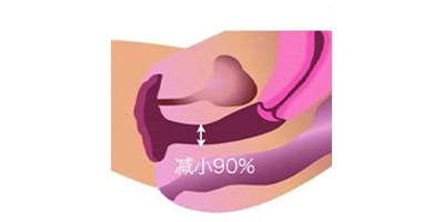 私密超聲提升術(shù)后