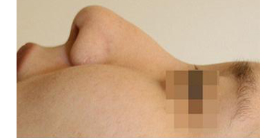 硅膠隆鼻術(shù)前