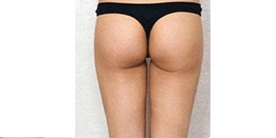 冷凍溶脂瘦臀部術(shù)后