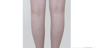 動氧瘦小腿術(shù)后