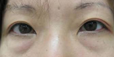 眼袋修復(fù)術(shù)前