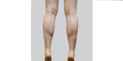 小腿神經阻斷術術前