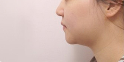 激光溶脂瘦臉術(shù)前