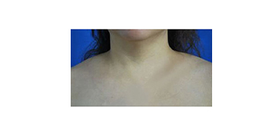 聚能震波吸脂術(shù)前