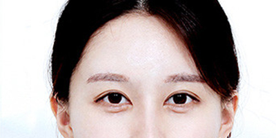 假體豐太陽穴術(shù)后