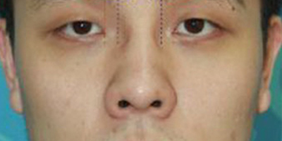 鼻孔矯正術(shù)后