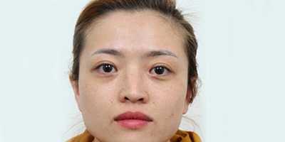 膨體隆鼻術(shù)前