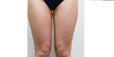 超聲溶脂瘦大腿術前