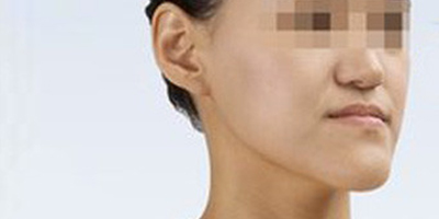 下顎前突/地包天術(shù)前