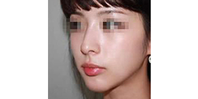 鷹鉤鼻矯正術(shù)后