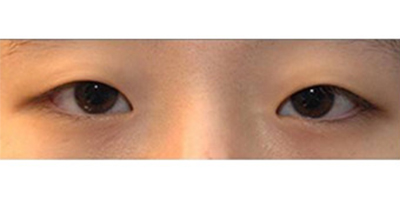 眼部多項術(shù)前