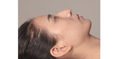 長(zhǎng)鼻矯正術(shù)前