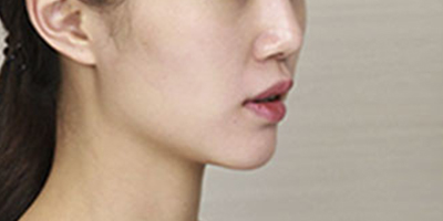 玻尿酸豐蘋果肌術前