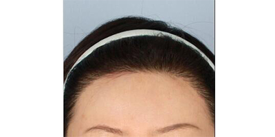 脫發(fā)際線術(shù)后