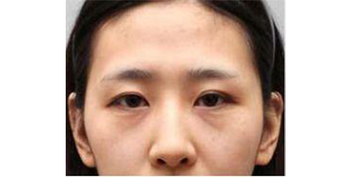 膠原蛋白填充淚溝術前