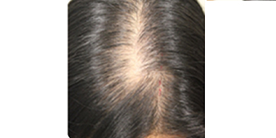 頭頂加密種植術(shù)前