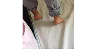 腳跟不著地矯正術(shù)前