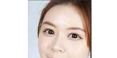 玻尿酸豐臥蠶術(shù)后