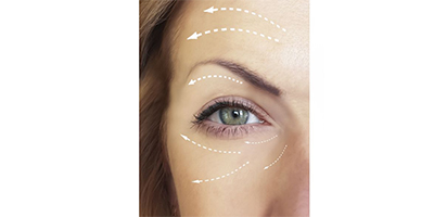 玻尿酸豐眼窩術(shù)后