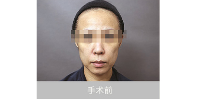 自體脂肪存儲(chǔ)術(shù)前