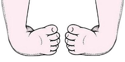 足內(nèi)翻矯正術(shù)前
