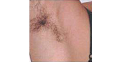 激光除腋臭術前