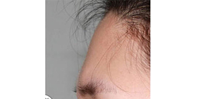 玻尿酸豐額頭術(shù)前